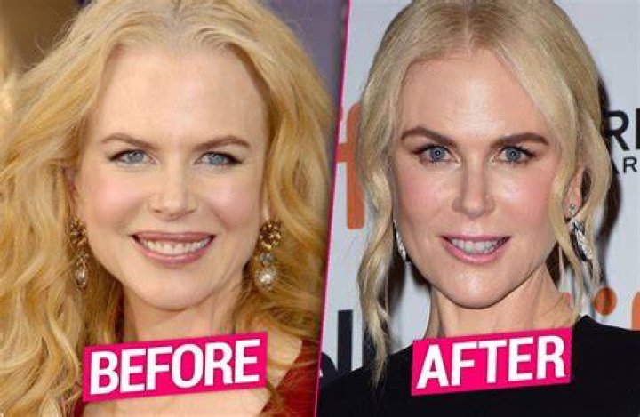 nicole kidman Botched Plastic Surgery, Bad Plastic Surgeries, Plastic